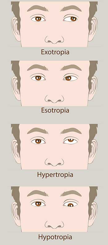 amblyopia