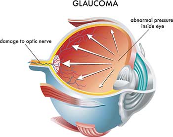 glaucoma